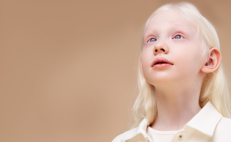 El Albinismo y la Salud Visual